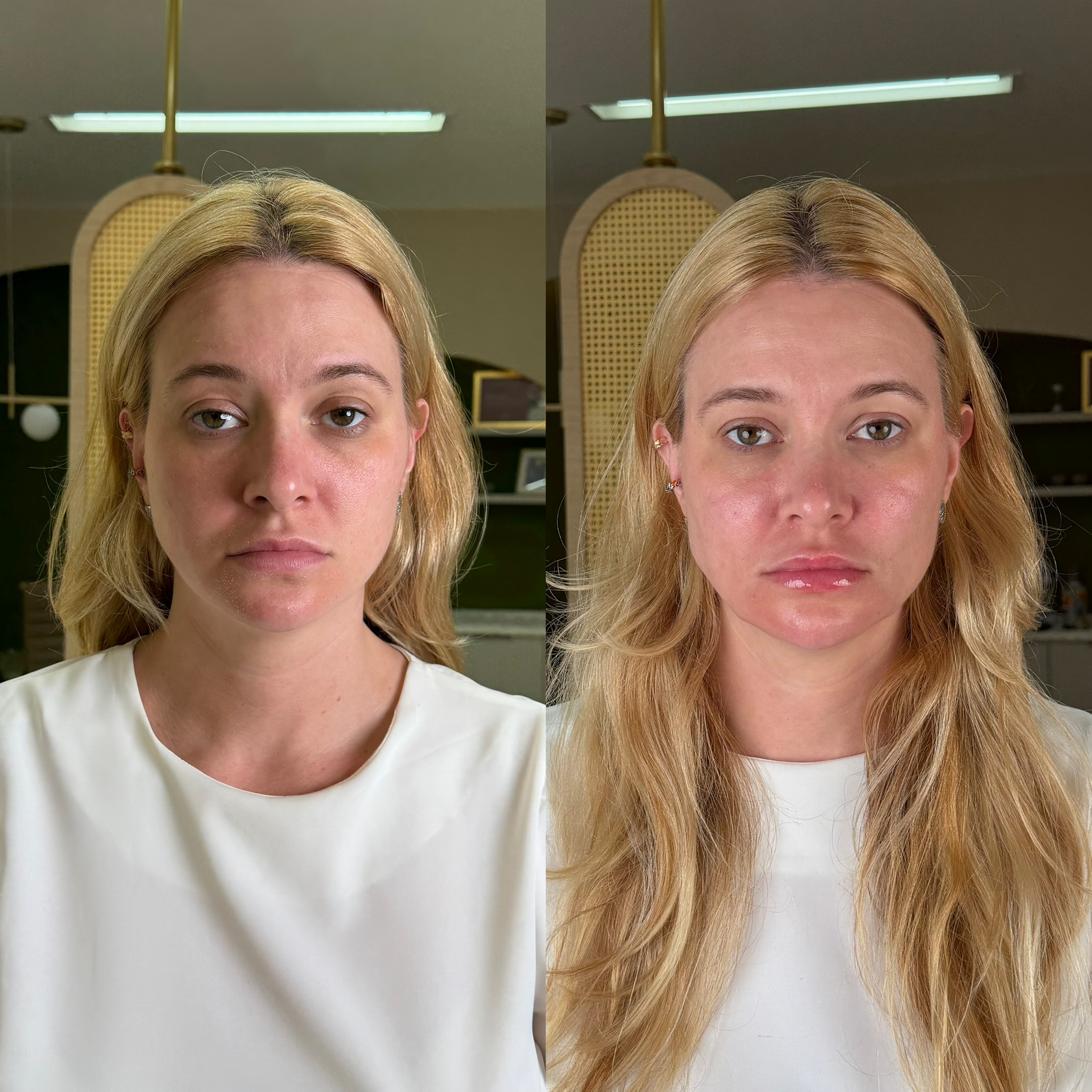 Harmonização full face — antes e depois caso 02