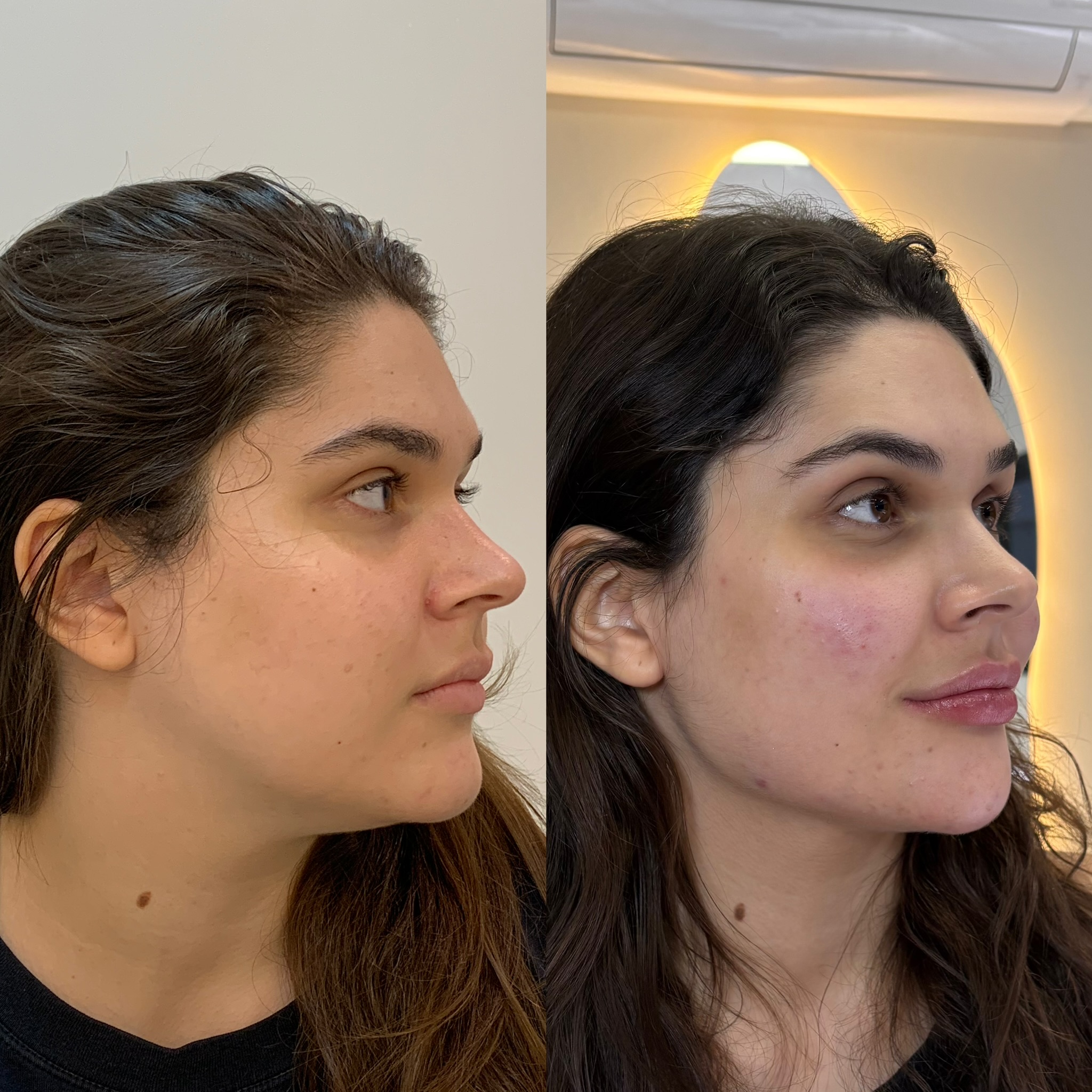 Harmonização full face — antes e depois caso 03