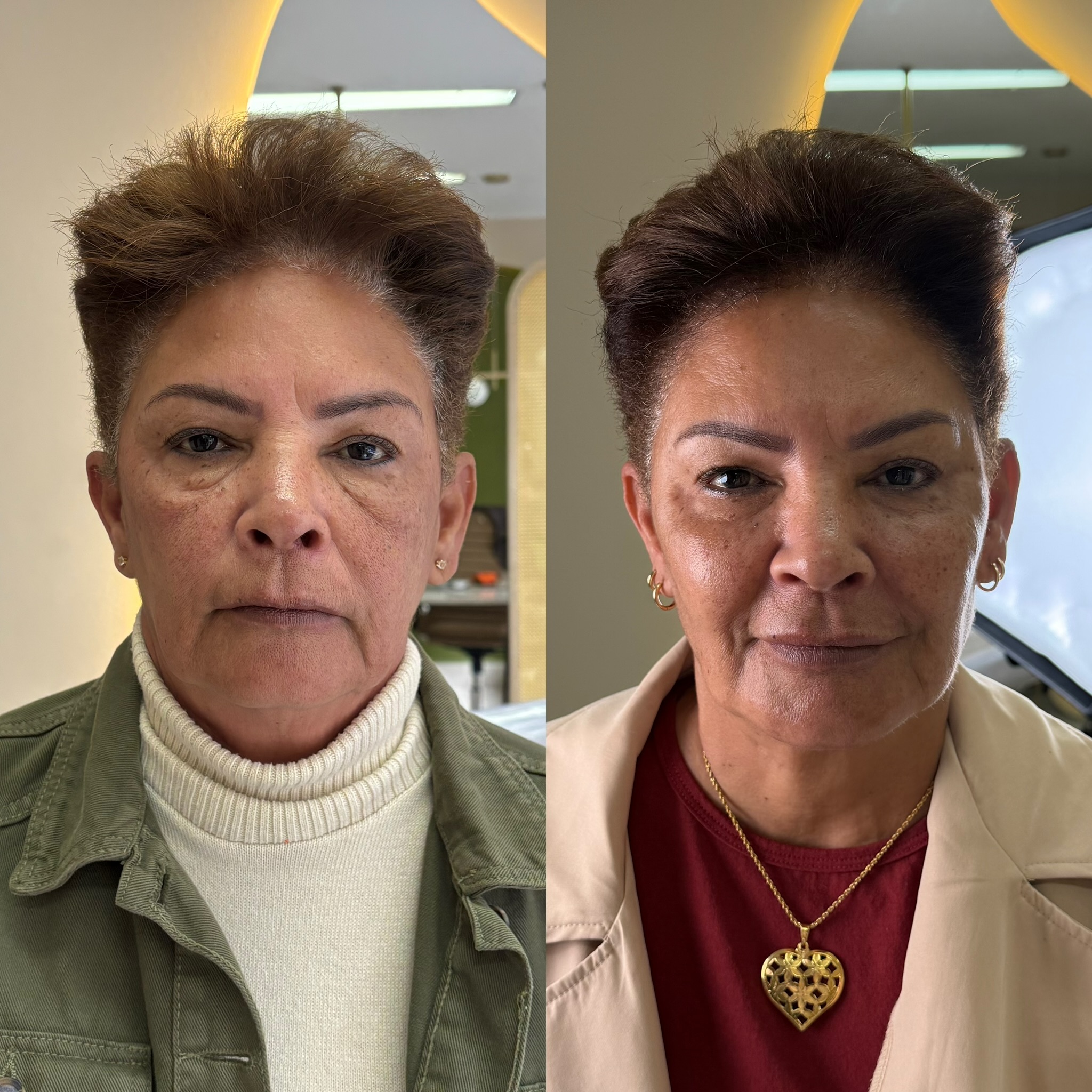 Harmonização full face — antes e depois caso 04